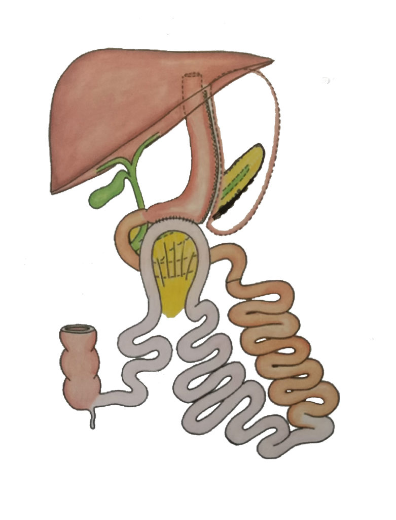 Illustration de la procédure SASI - SADI pour lutter contre l'obésité